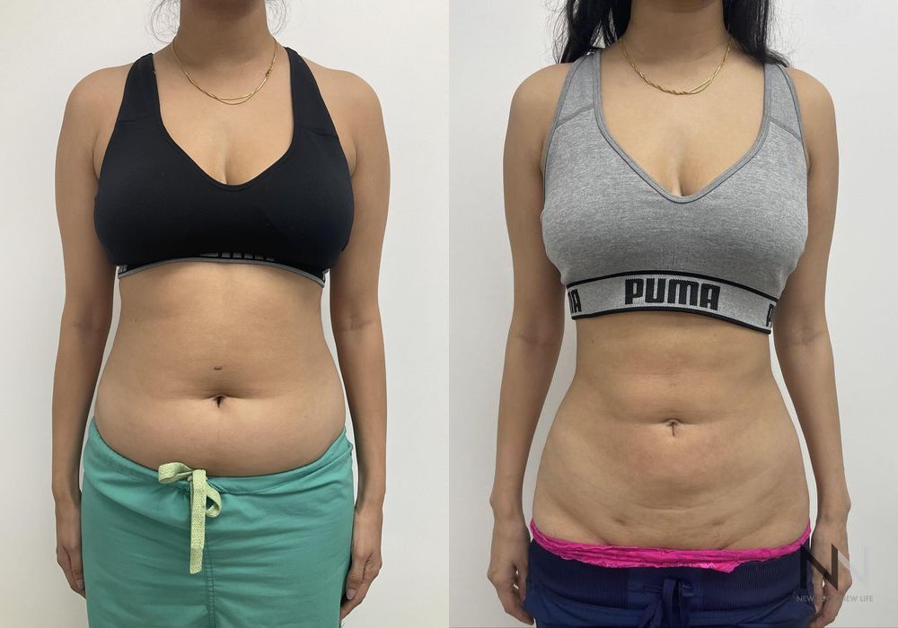 Liposuction - Case 2070