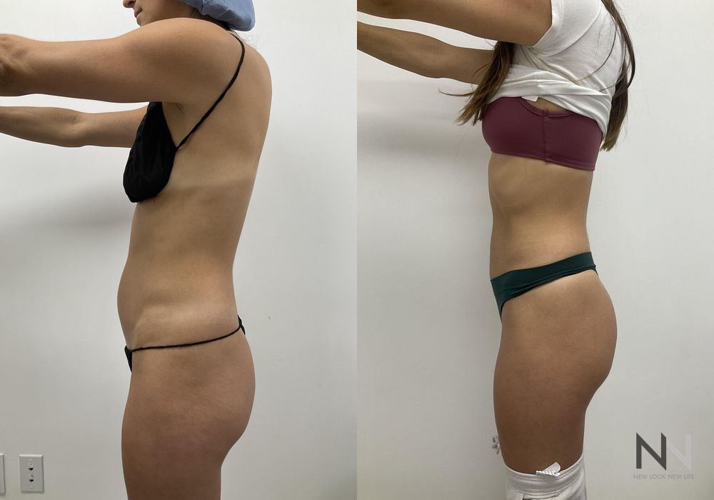 Liposuction - Thumbnail 4