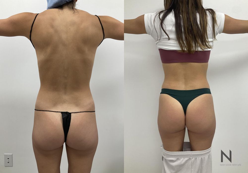 Liposuction - Case 1875