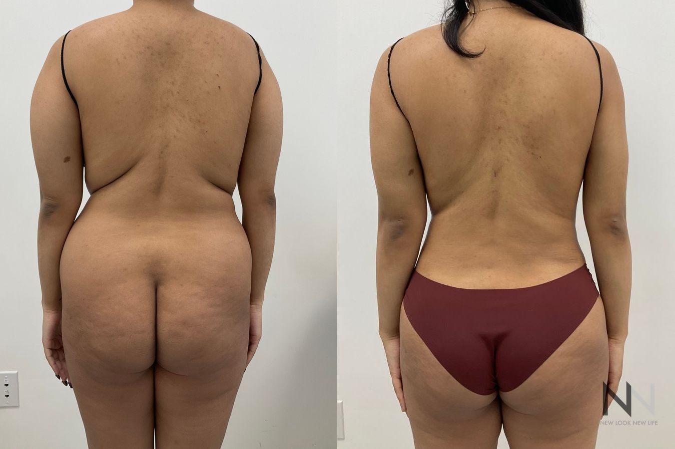Fat grafting before and after showing enhanced lateral hip contours following fat transfer by Dr. Claudia Kim in NYC. - Angle 2