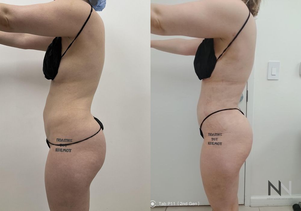 Liposuction - Thumbnail 3