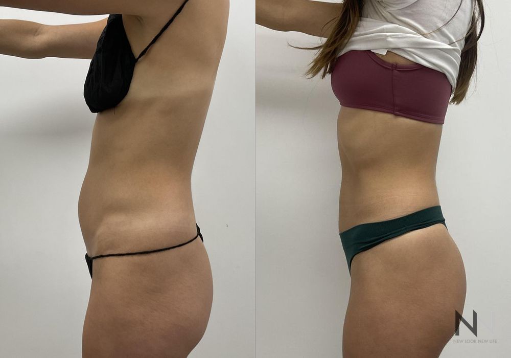 Liposuction - Thumbnail 3