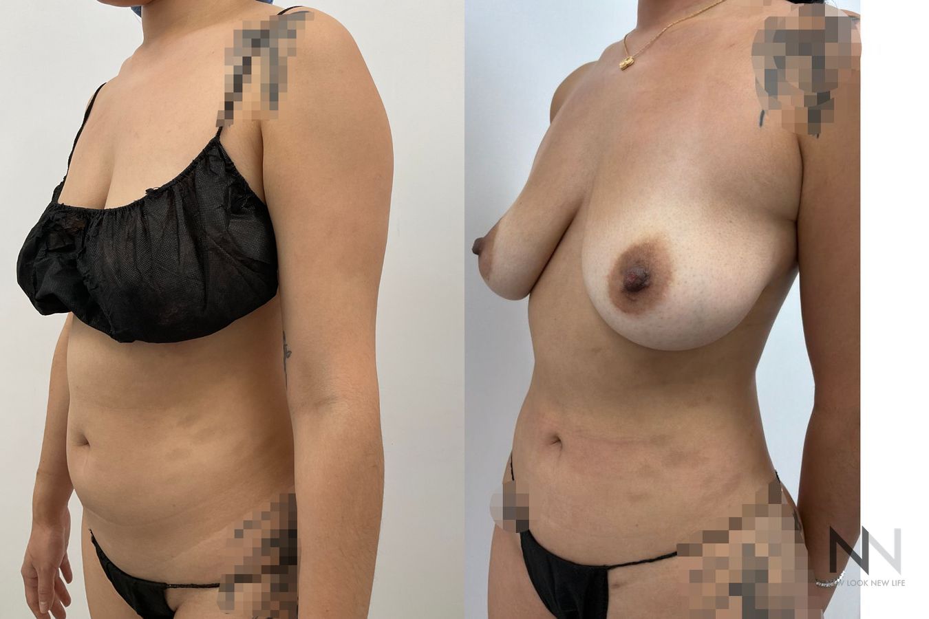 Liposuction before and after showing improved abdominal, flank, back and arm contours by Dr. Claudia Kim in NYC. - Angle 4