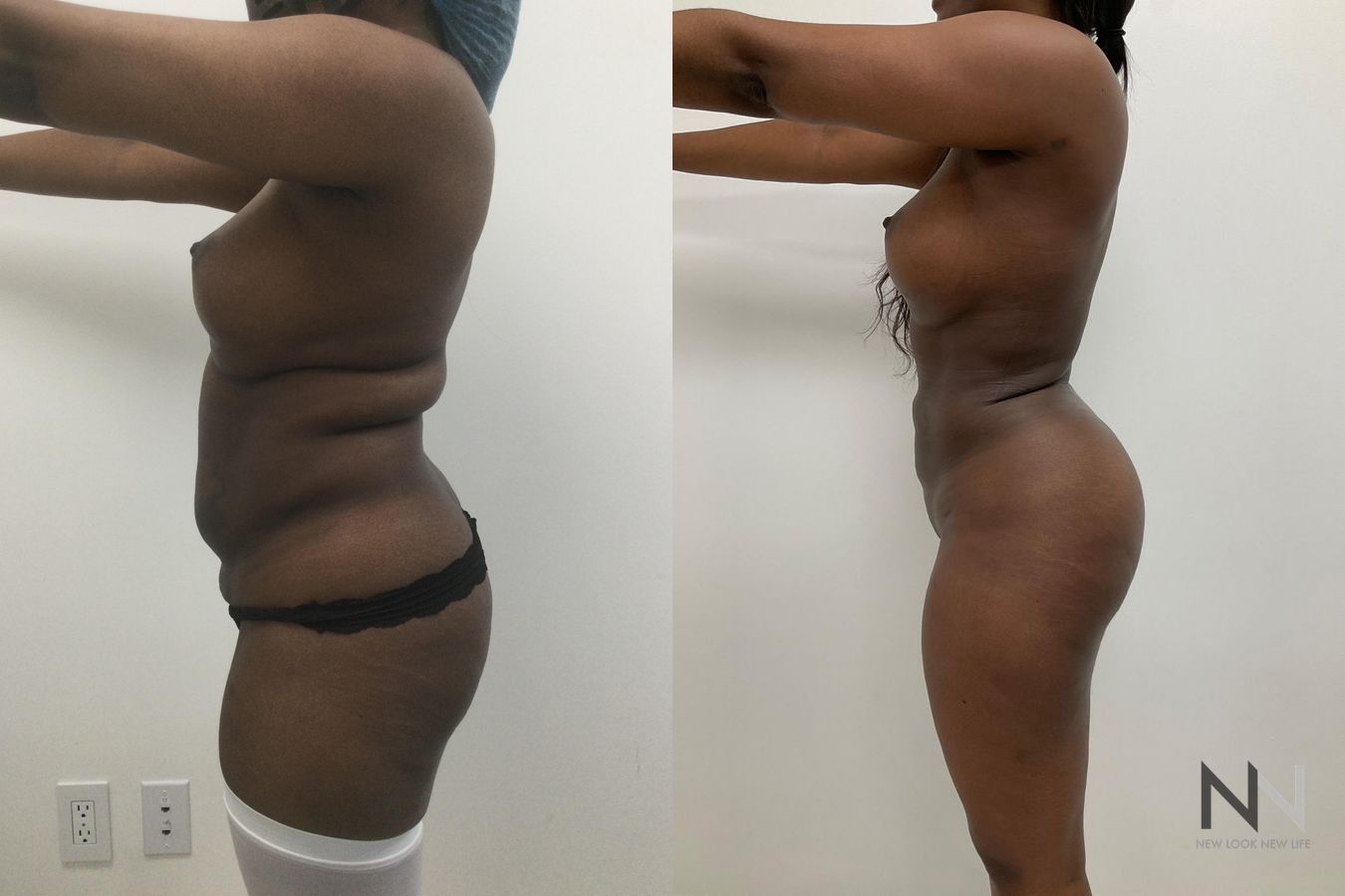 Before and after Lipo 360 six months results - Angle 3