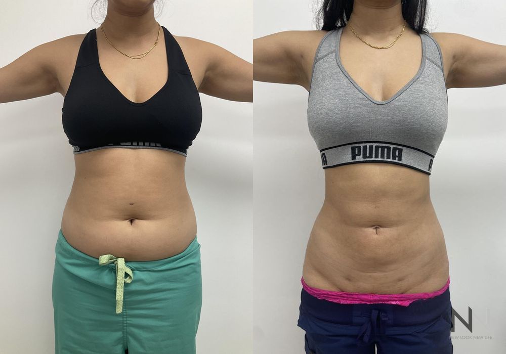 Liposuction - Thumbnail 2