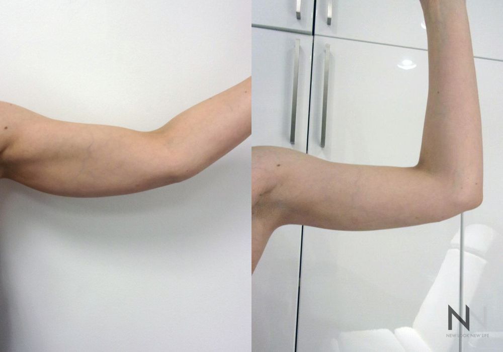 Liposuction - Thumbnail 2