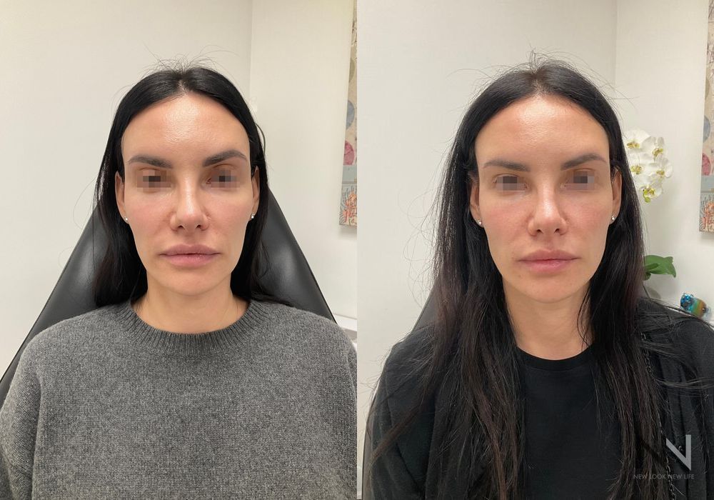 Liquid Facelift - Case 1713