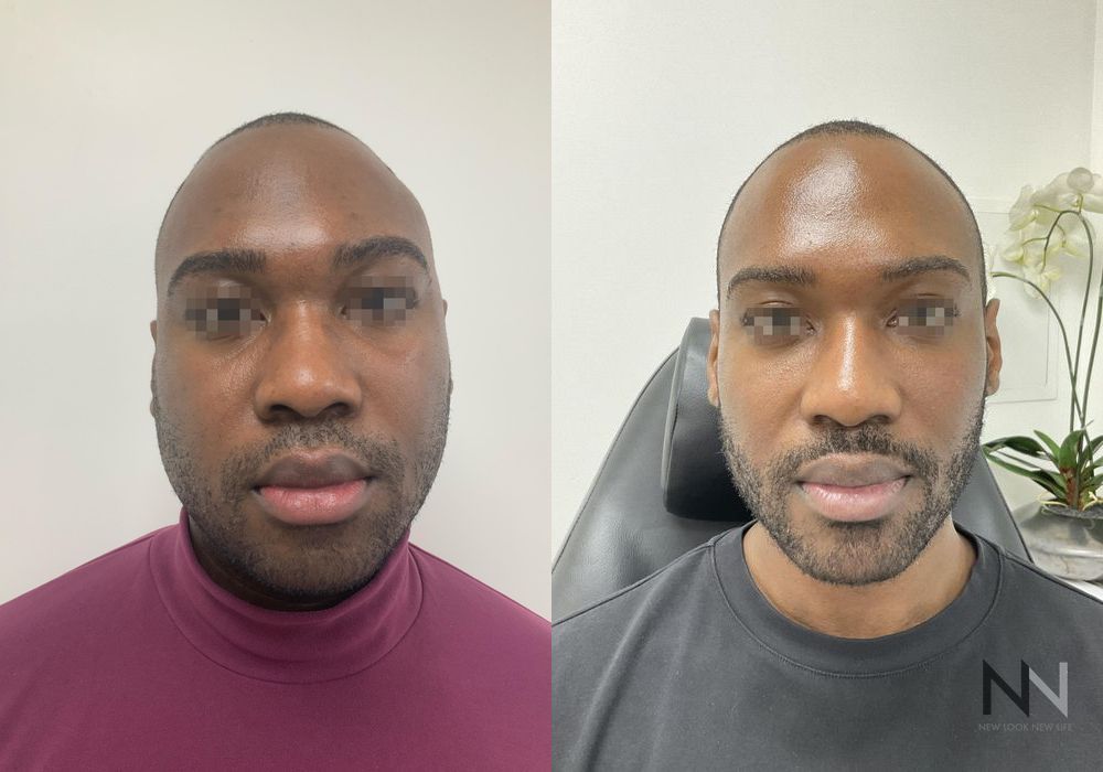 Liquid Facelift - Case 2235