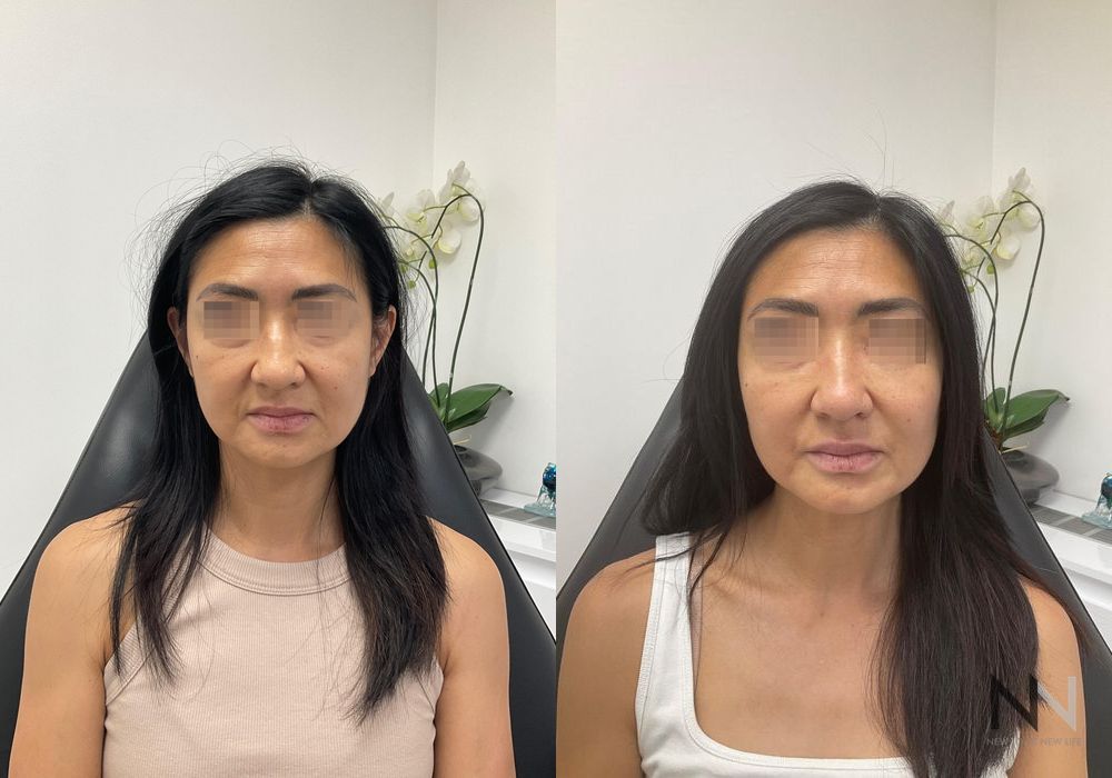 Liquid Facelift - Case 1700