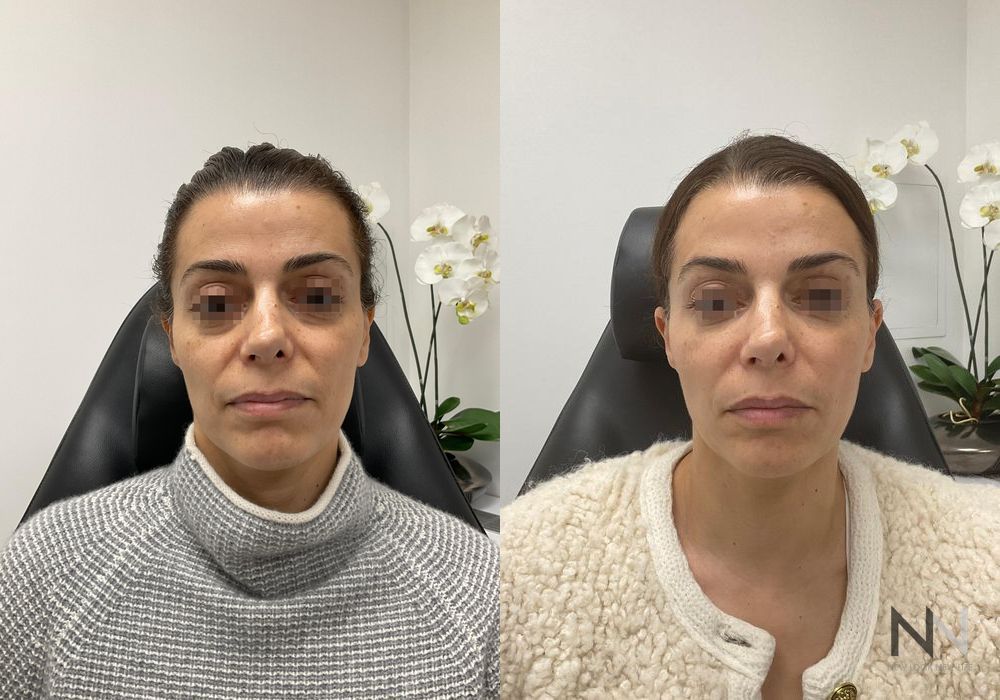 Liquid Facelift - Case 1709