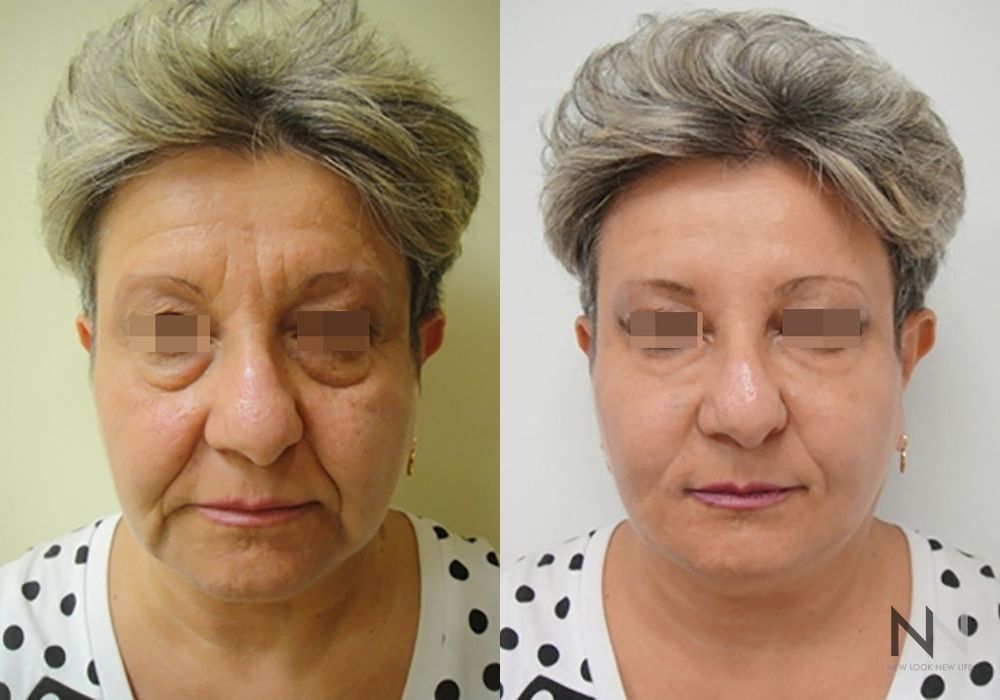 Liquid Facelift - Case 2236