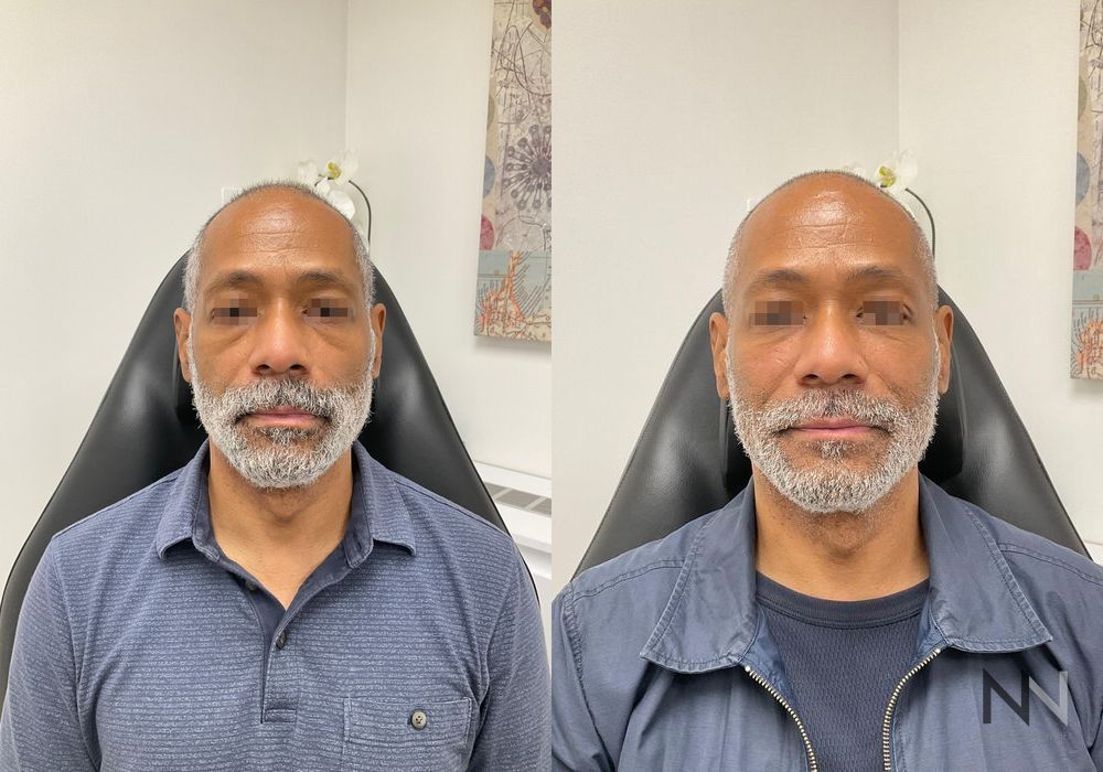 Liquid Facelift - Case 2242