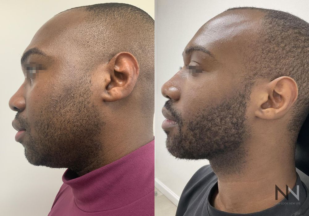 Liquid Facelift - Thumbnail 3