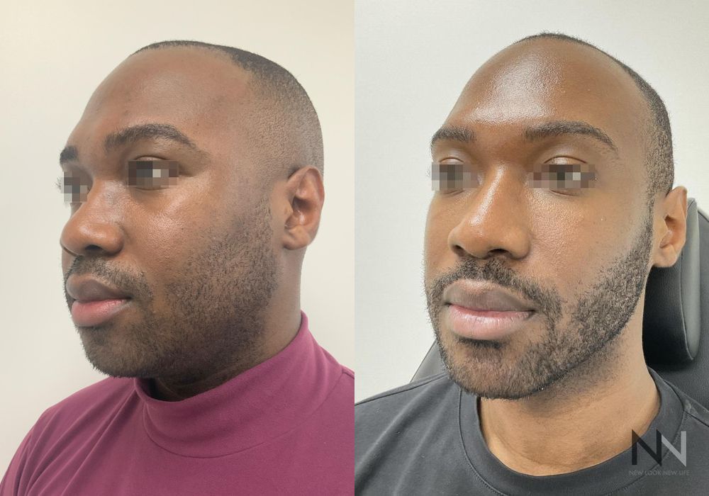 Liquid Facelift - Thumbnail 3