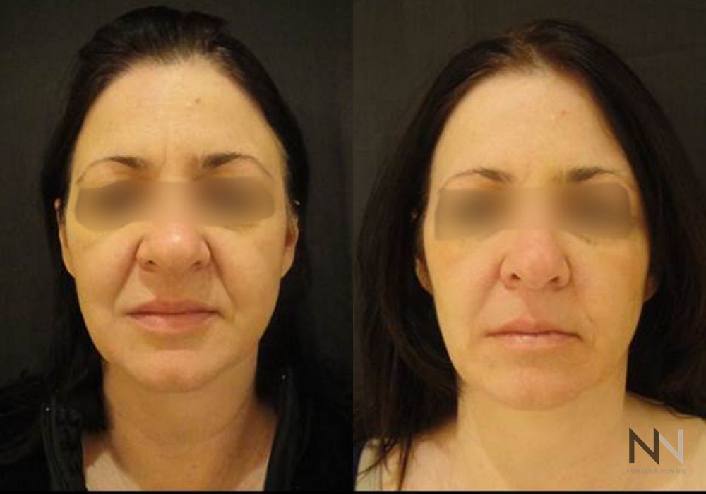 Liquid Facelift - Case 1706