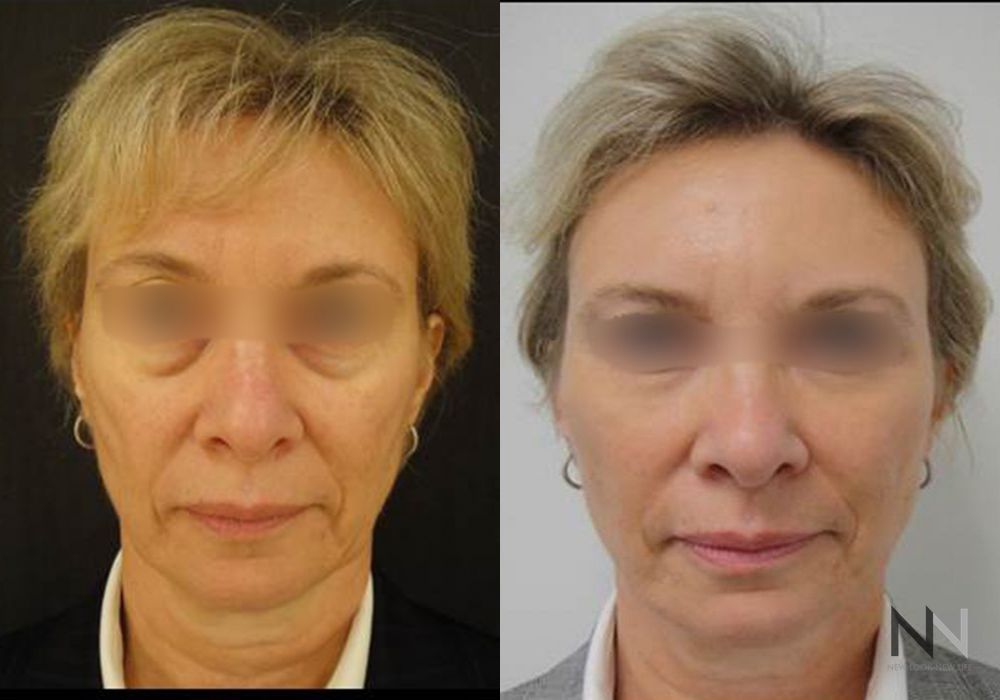 Liquid Facelift - Case 2239