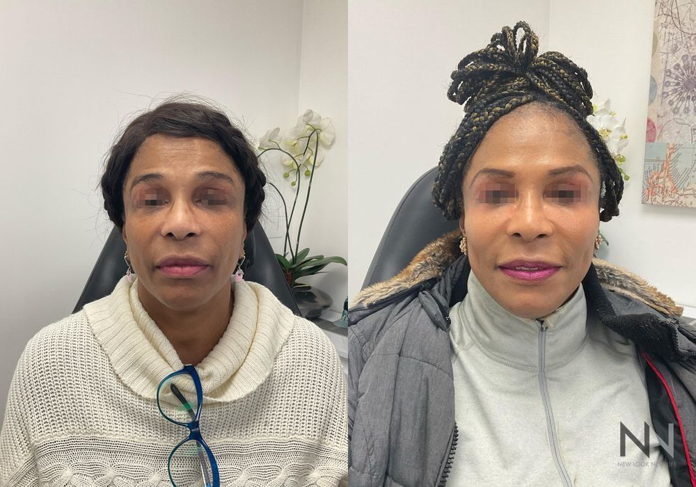 Liquid Facelift - Case 2243