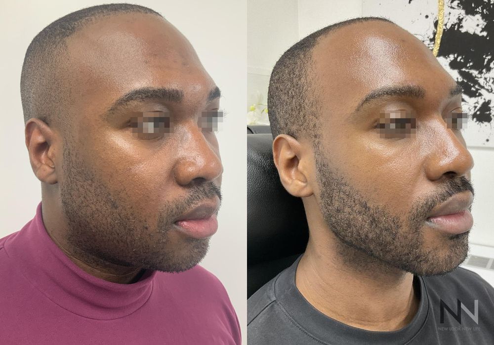 Liquid Facelift - Thumbnail 5