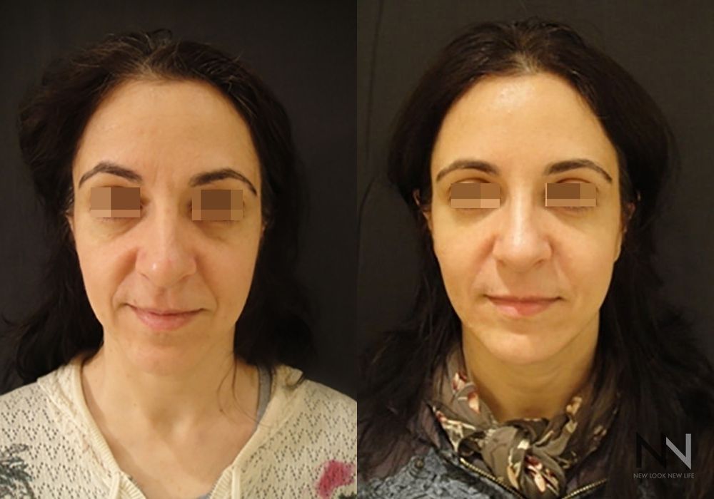 Liquid Facelift - Case 2232