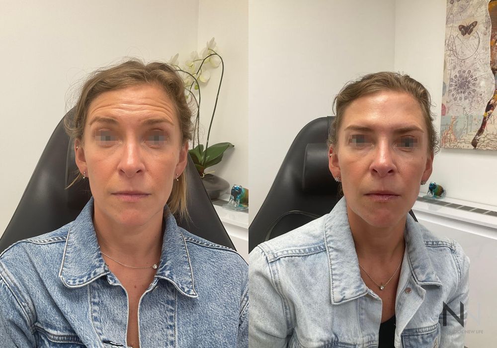 Liquid Facelift - Case 2241