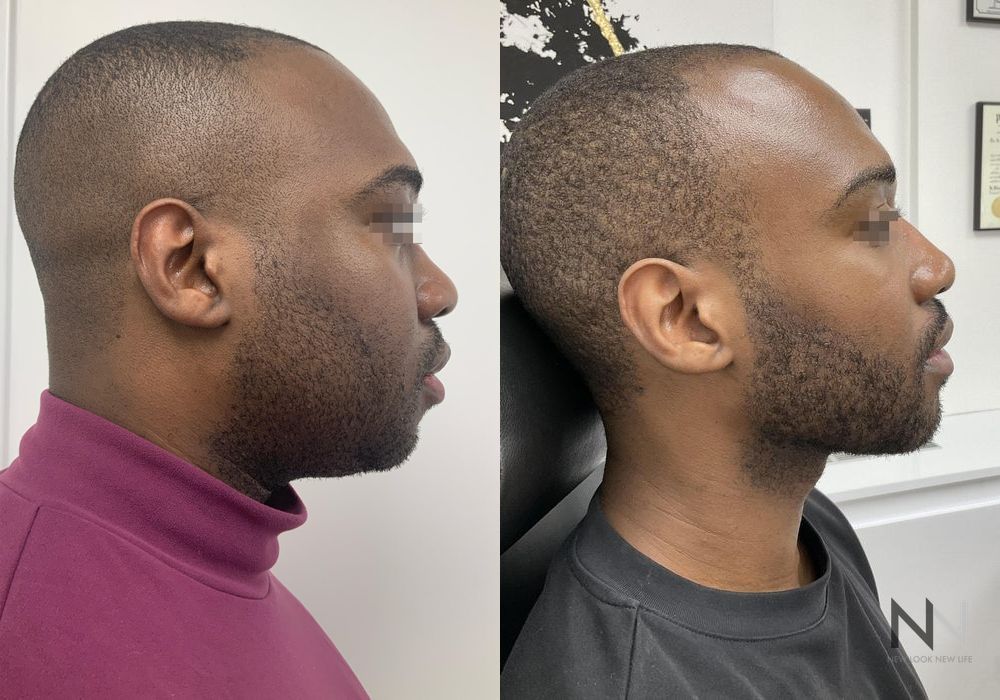 Liquid Facelift - Thumbnail 5