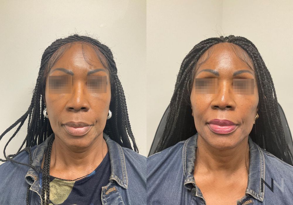 Liquid Facelift - Case 2233