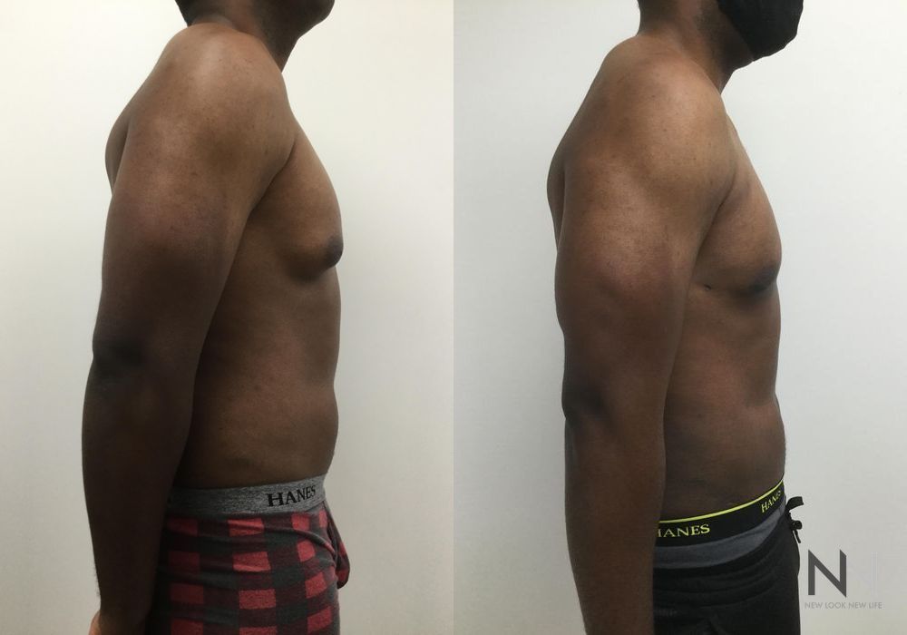 Male Liposuction - Thumbnail 3