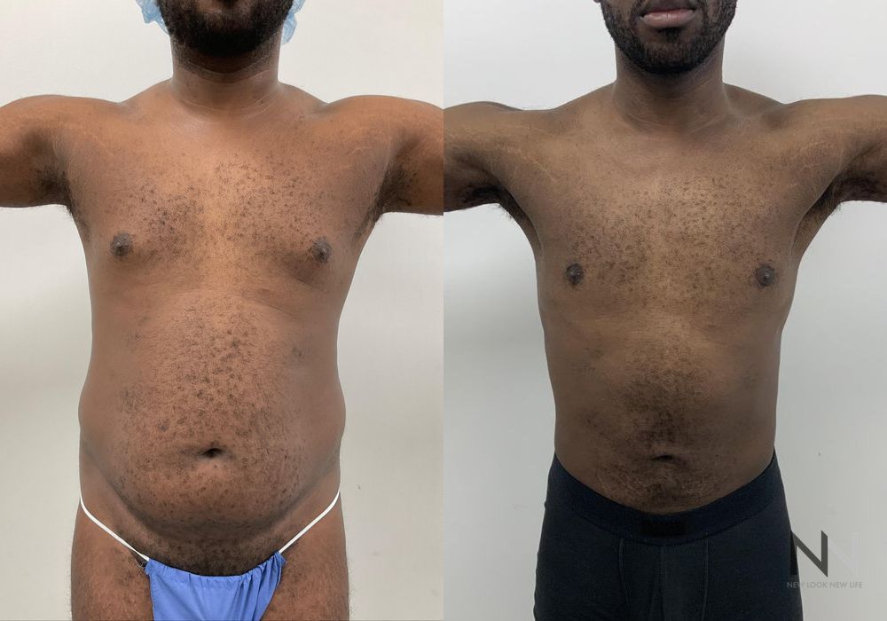 Before and after Gynecomastia case 21001