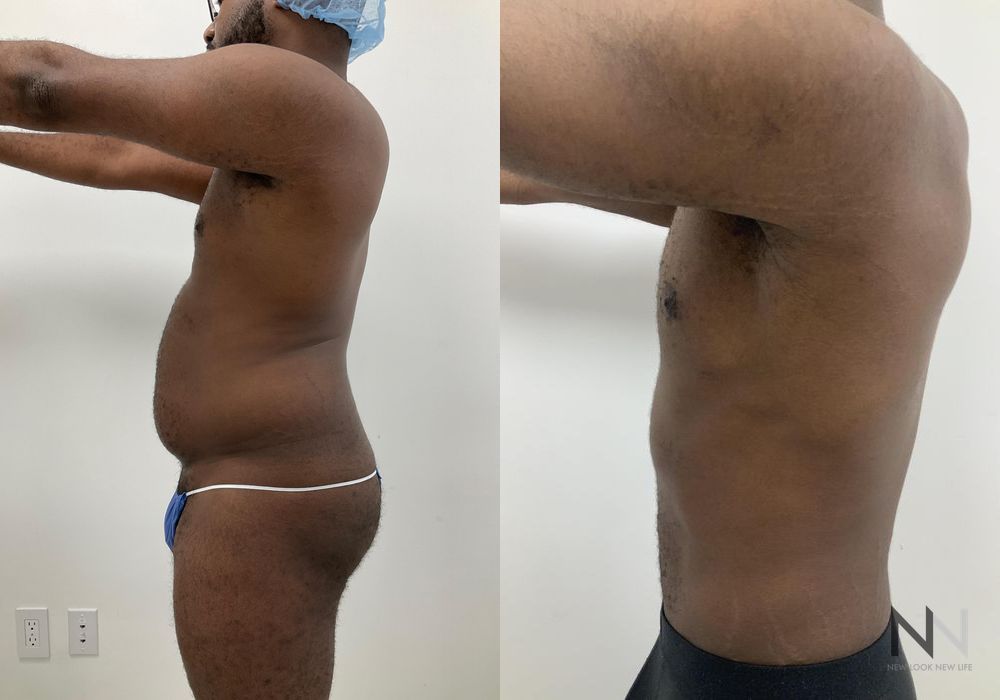 Male Liposuction - Thumbnail 3