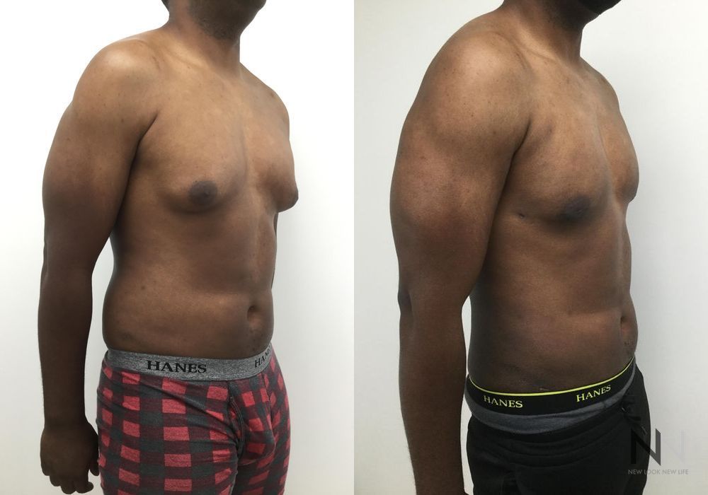 Male Liposuction - Thumbnail 2
