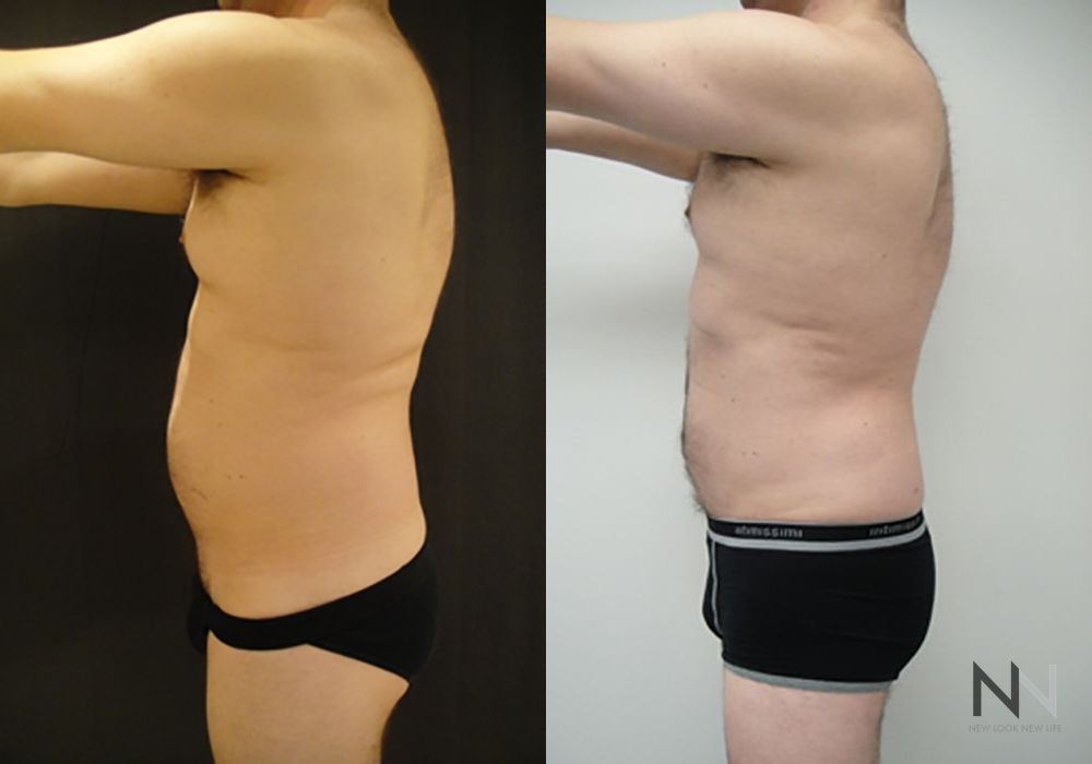 Male Liposuction - Case 2304