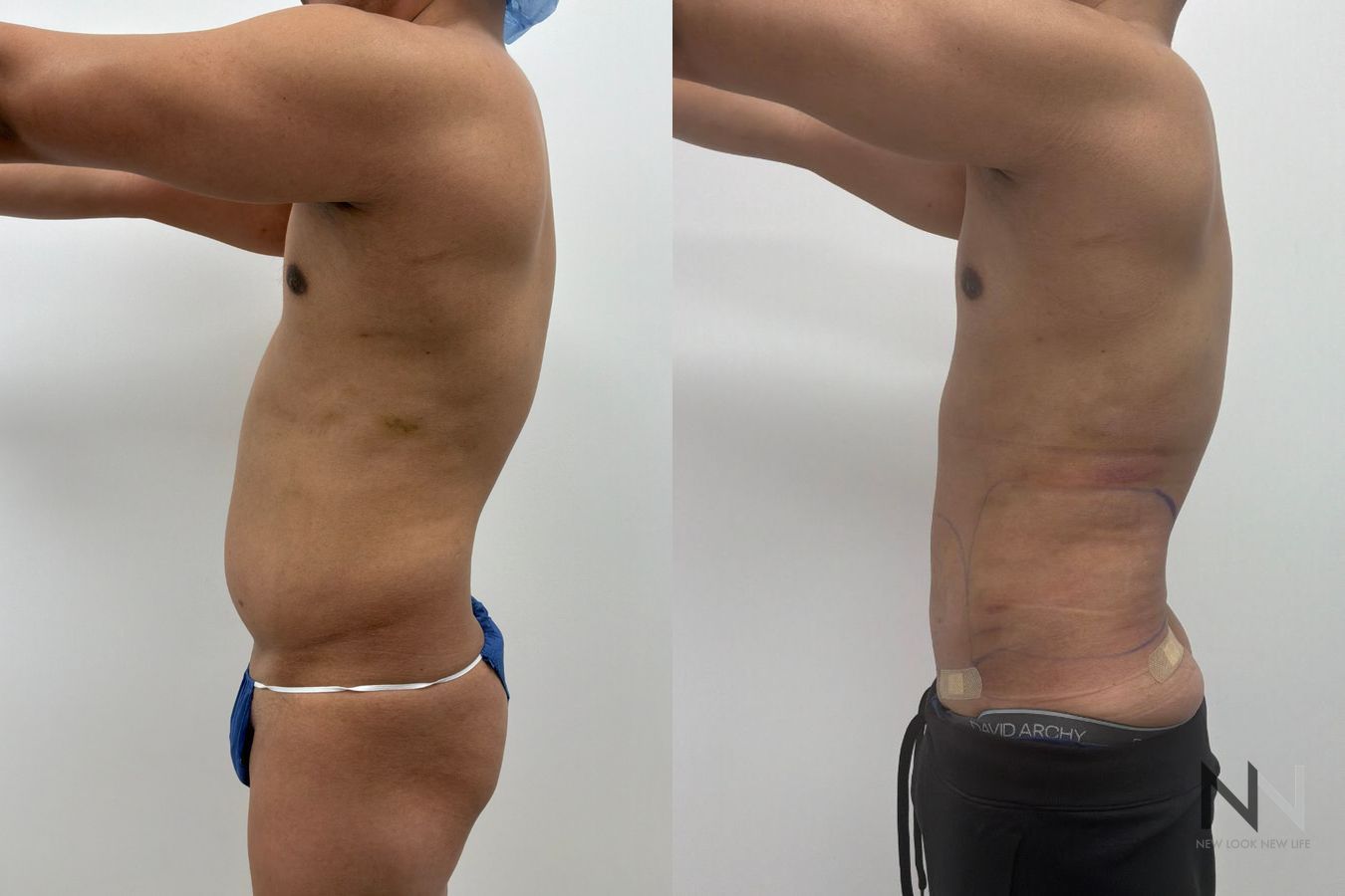 Male liposuction before and after showing refined abdominal, flank and lower back contours by Dr. Claudia Kim in NYC. - Angle 4