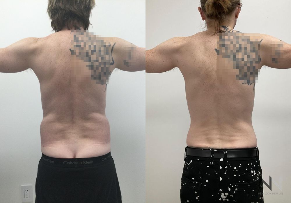 Male Liposuction - Thumbnail 6