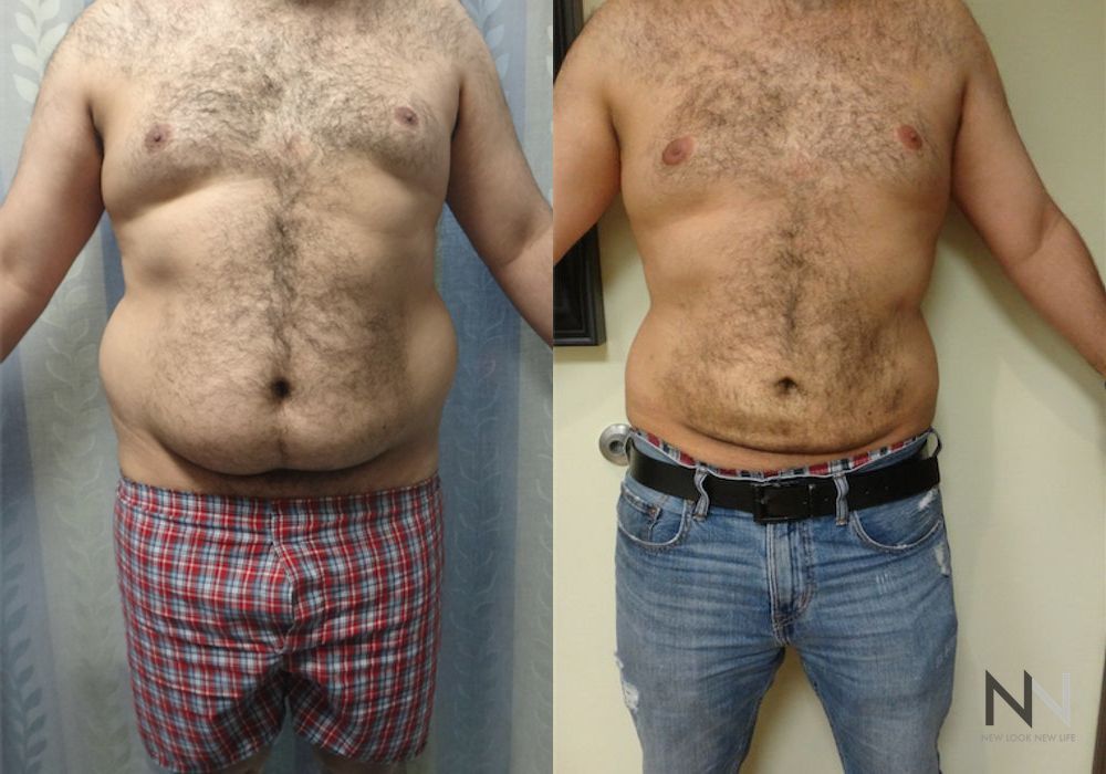 Male Liposuction - Case 2303