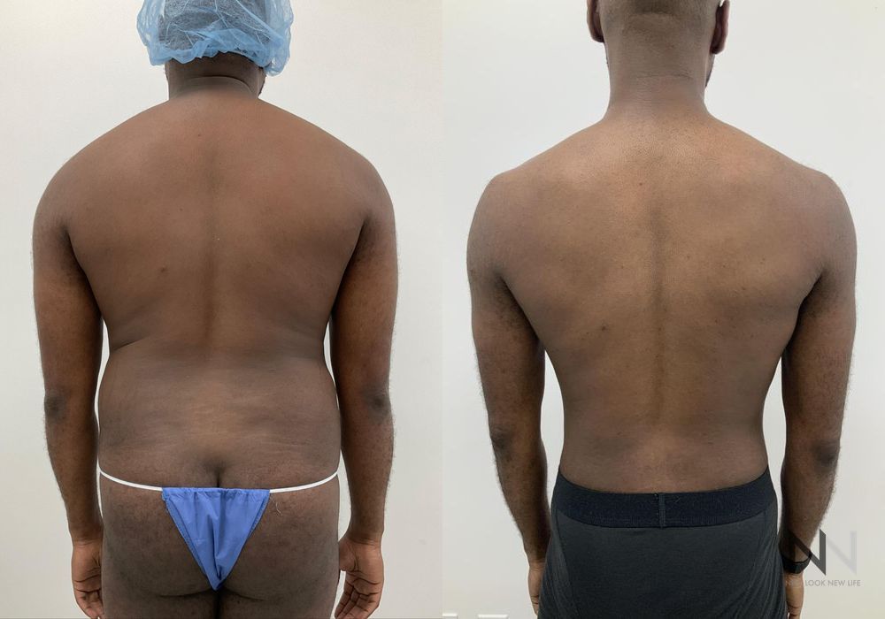 Before and after Gynecomastia case 21001 - Angle 7
