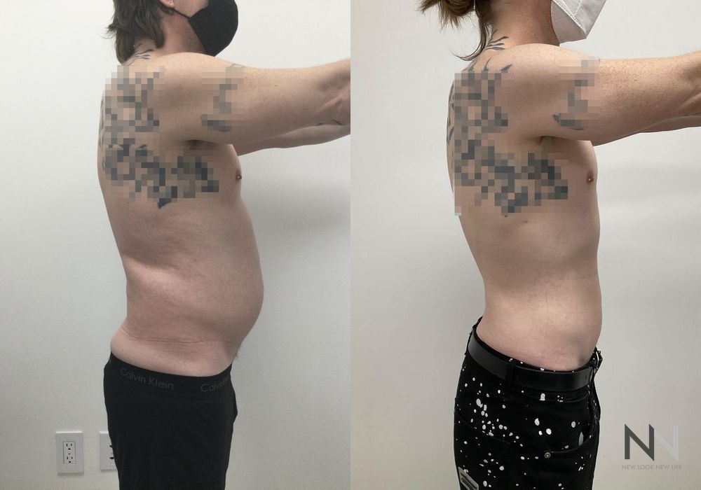 Male Liposuction - Thumbnail 3