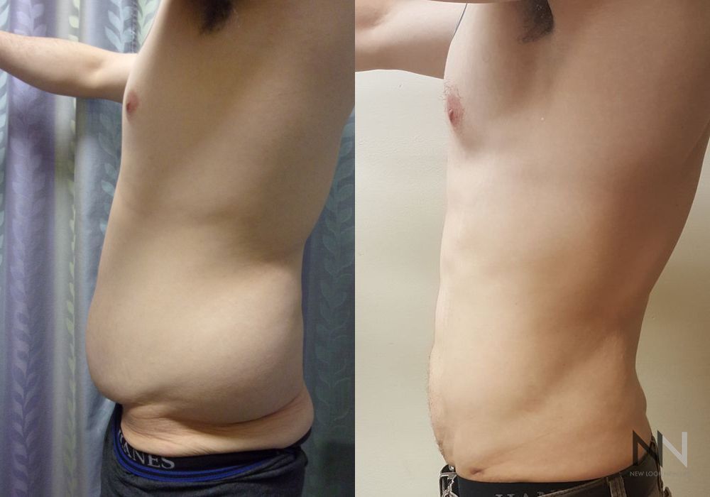 Male Liposuction - Thumbnail 3