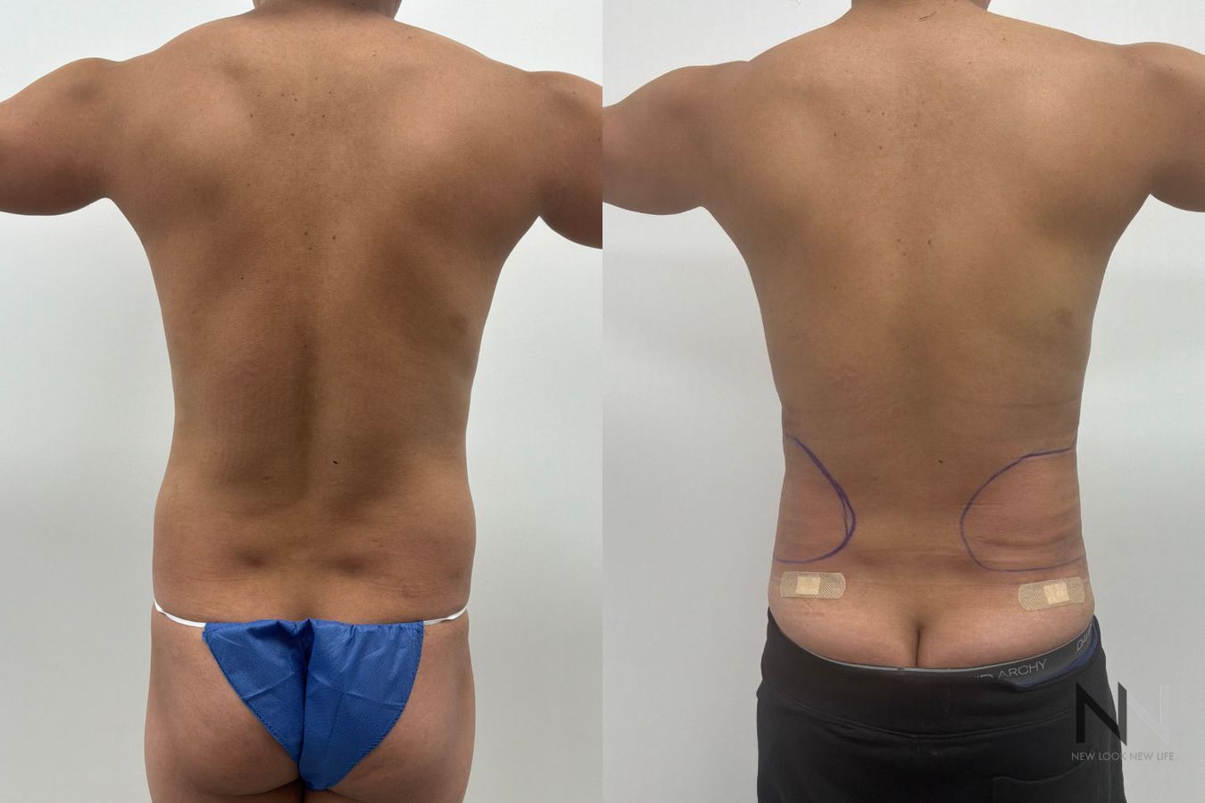 Male liposuction before and after showing refined abdominal, flank and lower back contours by Dr. Claudia Kim in NYC. - Angle 3