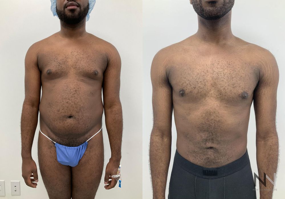 Male Liposuction - Case 1768
