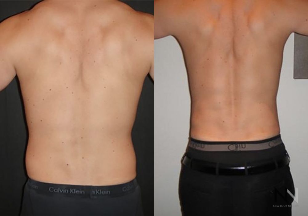 Male Liposuction - Case 86