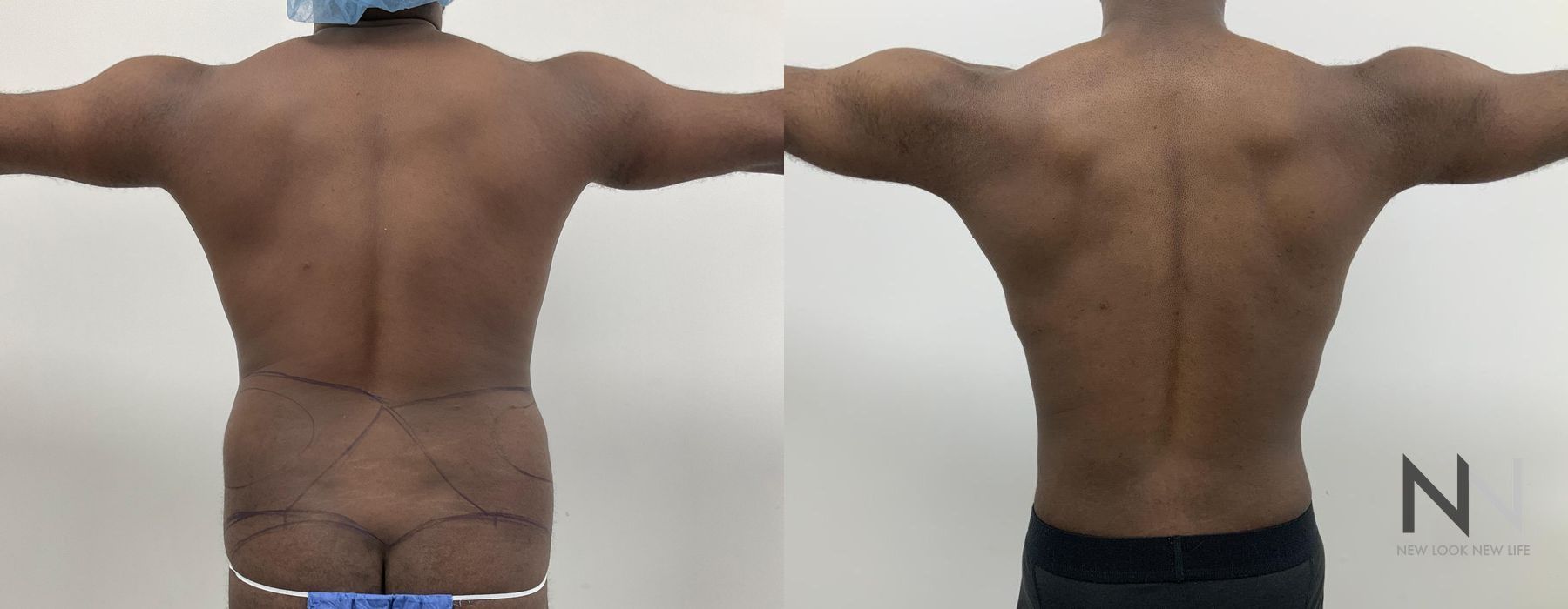 Before and after Gynecomastia case 21001 - Angle 5