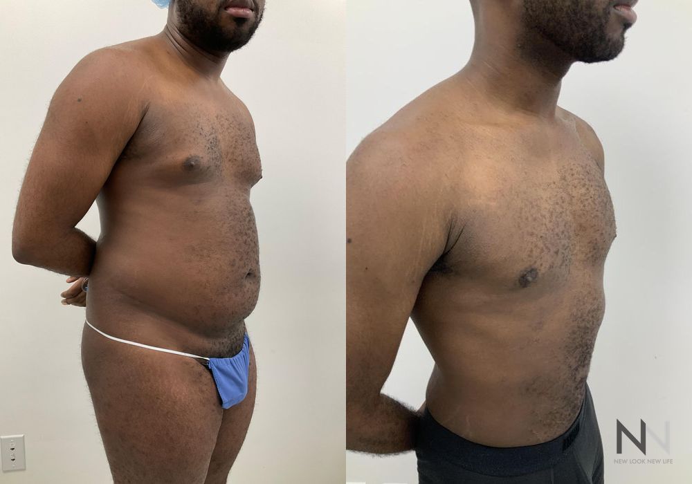 Male Liposuction - Thumbnail 5