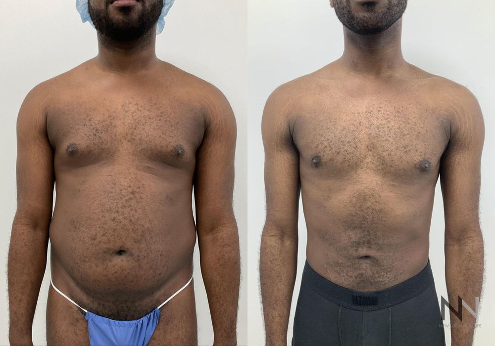 Before and after Gynecomastia case 21001 - Angle 2
