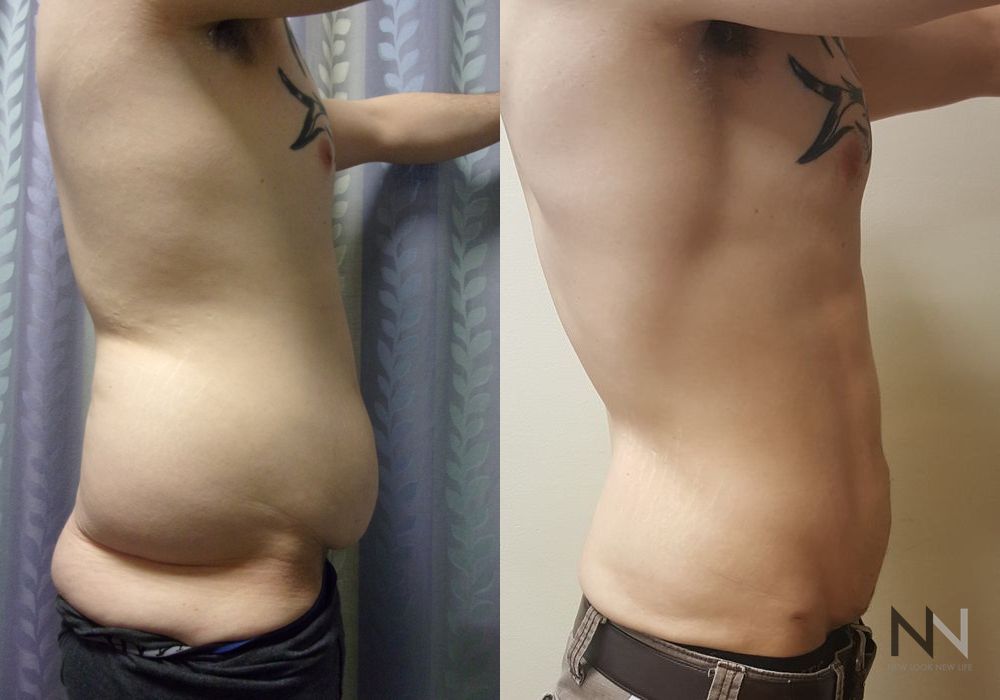 Male Liposuction - Thumbnail 2