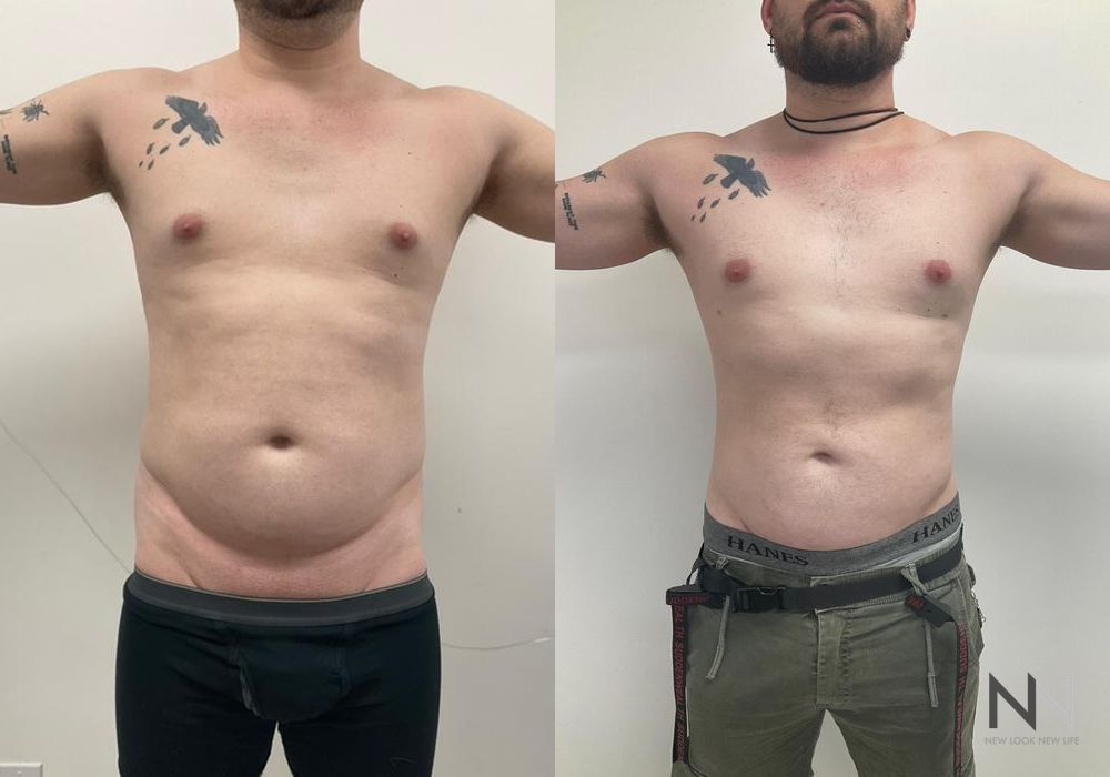 Male Liposuction - Case 81