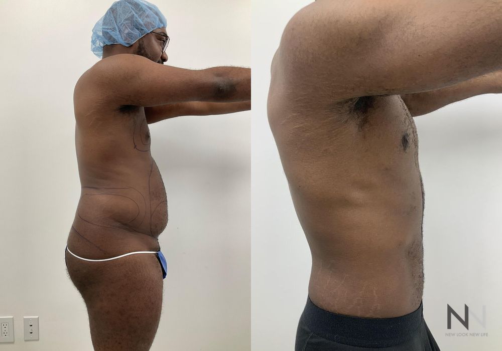 Male Liposuction - Thumbnail 4