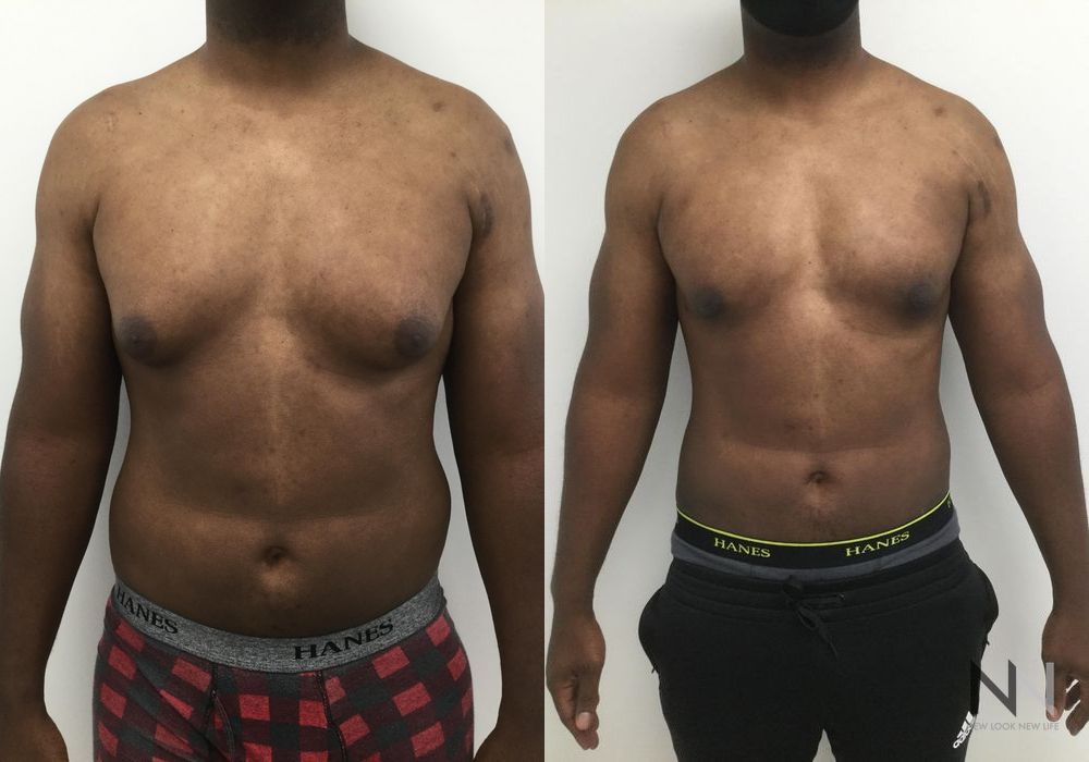 Male Liposuction - Case 82