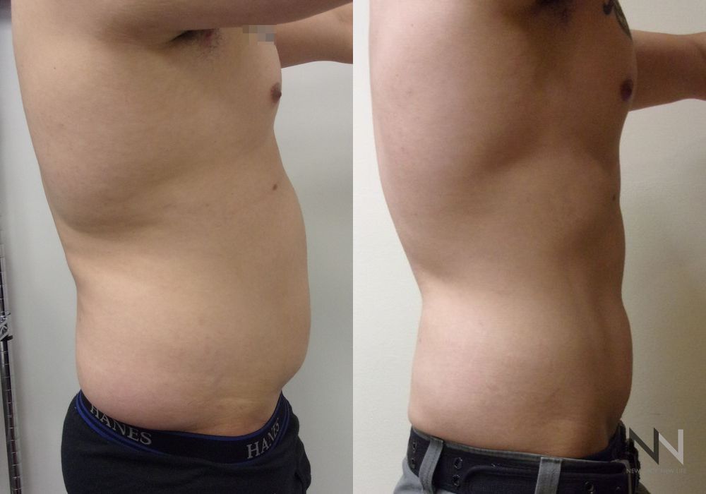Male Liposuction - Thumbnail 3