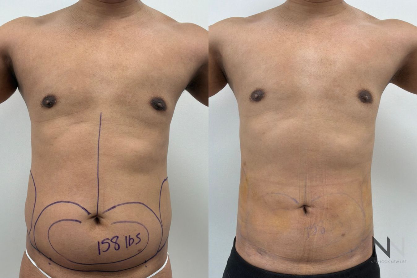 Male liposuction before and after showing refined abdominal, flank and lower back contours by Dr. Claudia Kim in NYC.