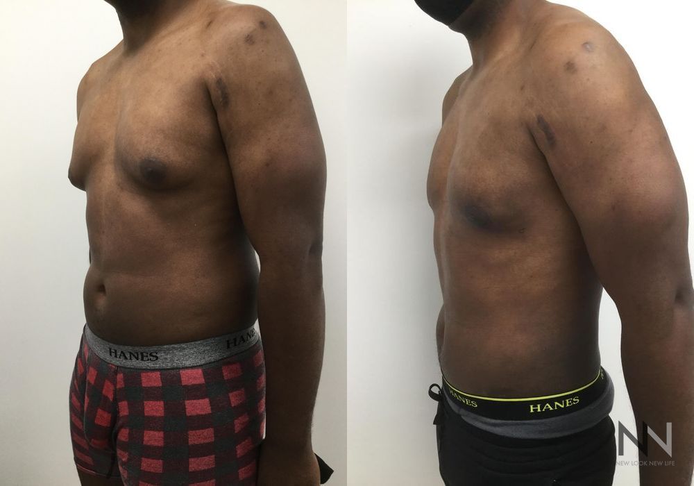Male Liposuction - Thumbnail 4